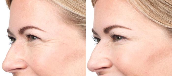 Lip Fillers Before & After Photo | San Luis Obispo, CA | The Aesthetic Center