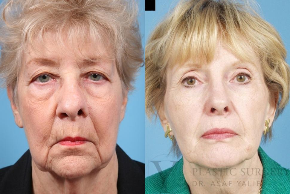 Lip Fillers Before & After Photo | San Luis Obispo, CA | The Aesthetic Center