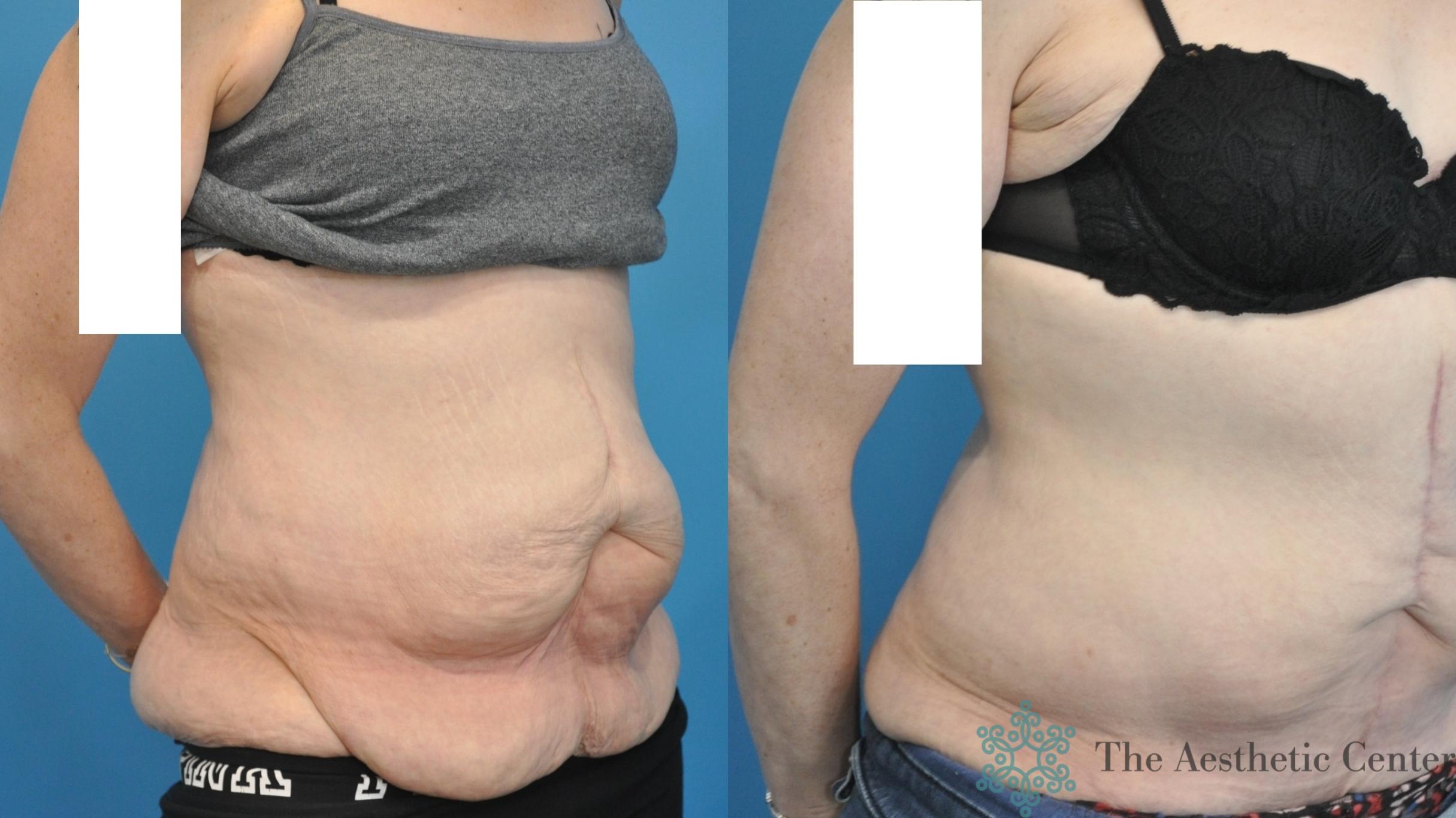 Tummy Tuck Before & After Photo | San Luis Obispo, CA | The Aesthetic Center