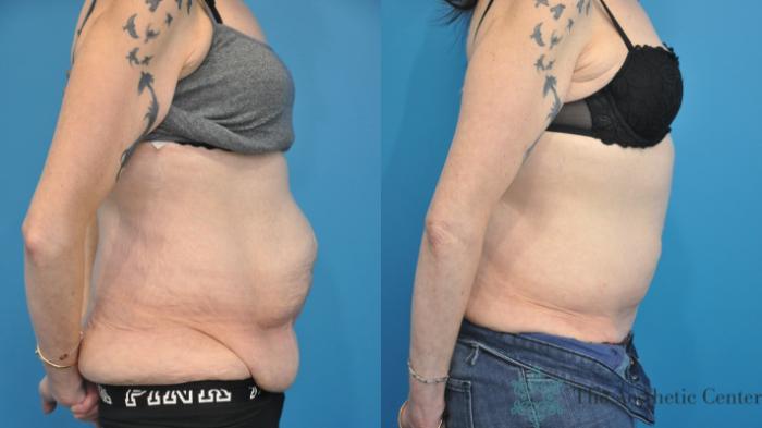 Tummy Tuck Before & After Photo | San Luis Obispo, CA | The Aesthetic Center